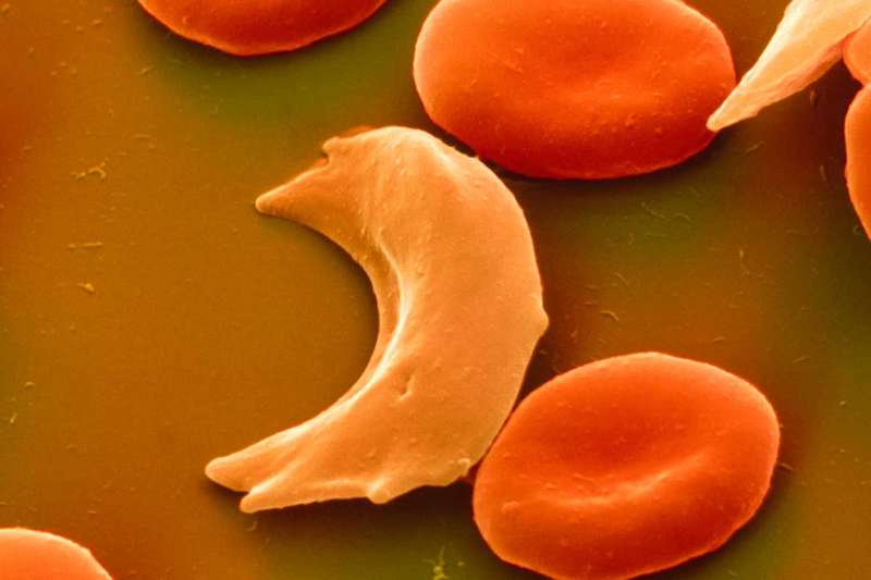Round and sickle shaped red blood cells