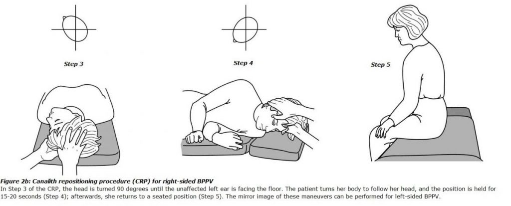 canalith repositioning procedure