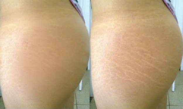 stretch marks on thighs