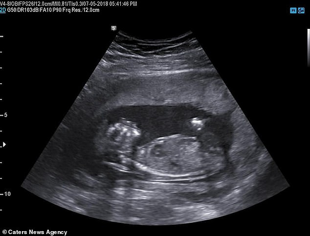 Rylei (pictured in an ultrasound) was diagnosed with the birth defect anencephaly in the womb