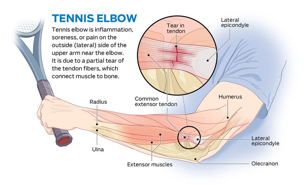 How To Get Rid Of Tennis Elbow