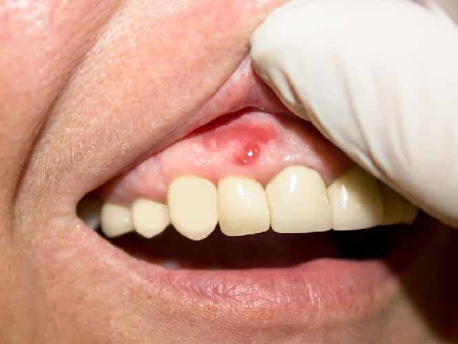 bump on gums not painful