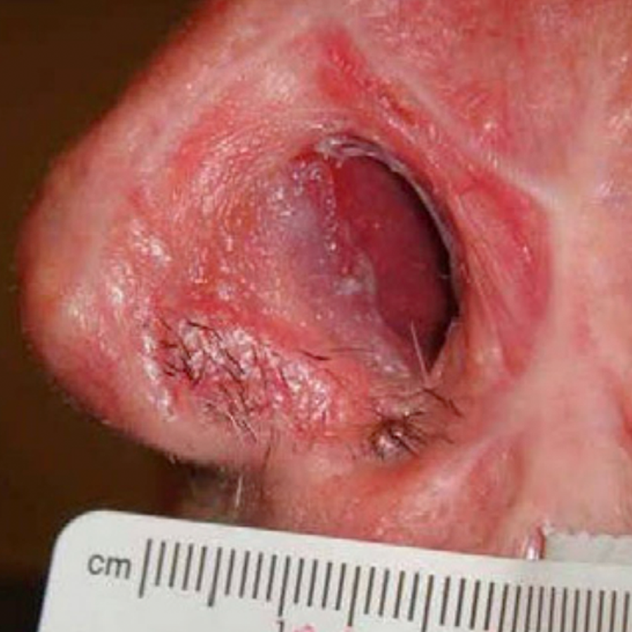 clinical photo of nose in profile, focusing on missing nostril, injury caused by black salve corrosive ointment