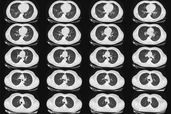 A computed tomography scan of the lungs of a healthy adult man. The panel recommended low-dose CT scans, so-called because they involve a relatively small amount of radiation, and cost about $ 300.